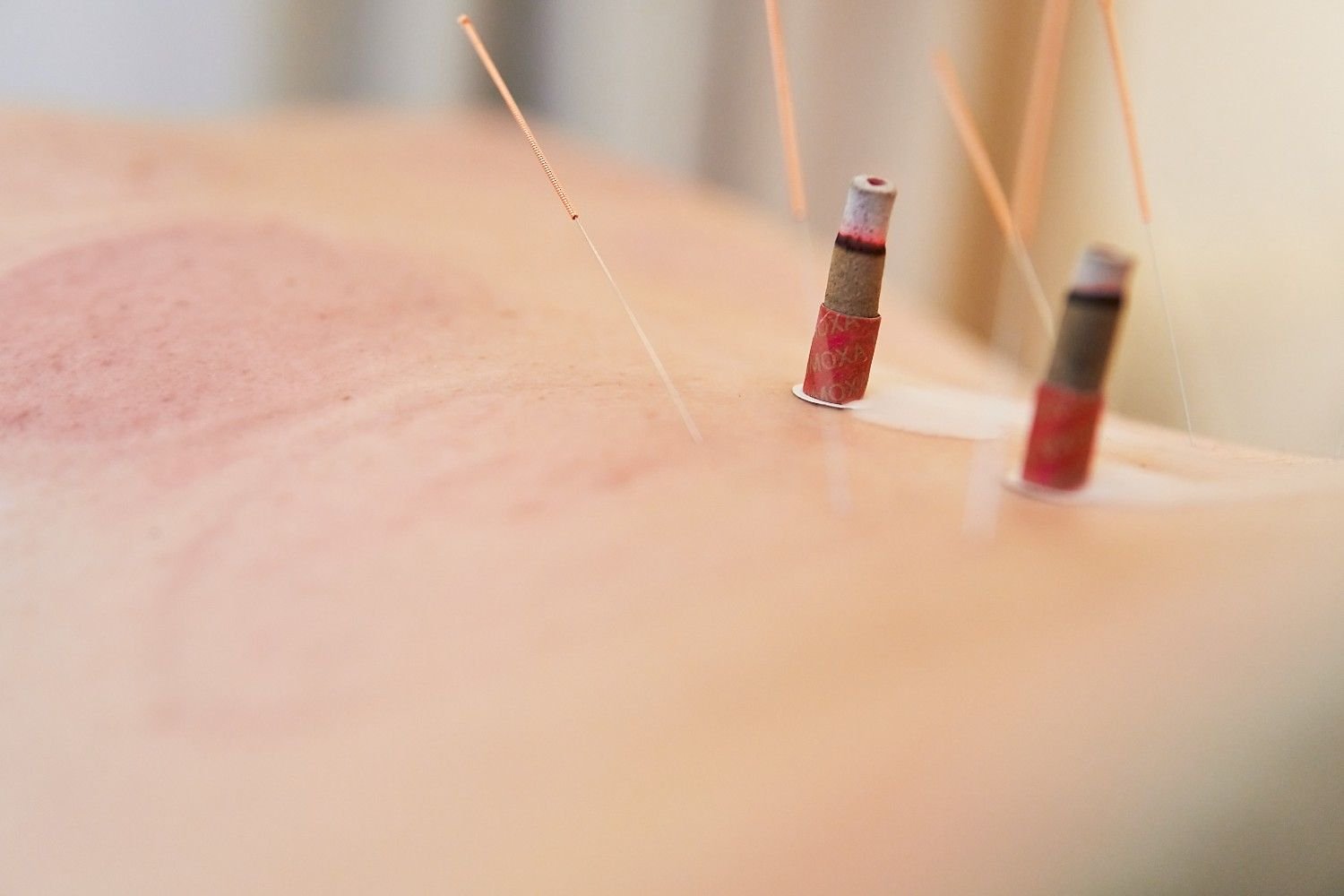 Dry Needling Therapy